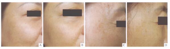 effect of GA in skin care